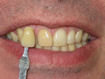 Teeth Whitening Before Photo