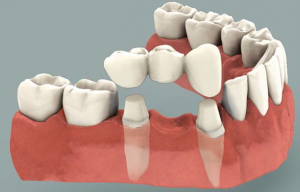Dental Bridge Illustration