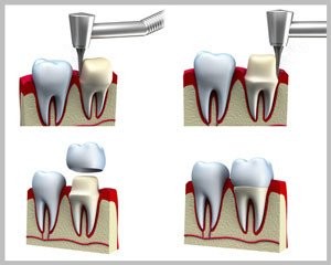 Dental Crown Process Illustration