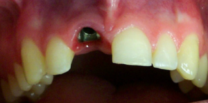 Dental Implant Before