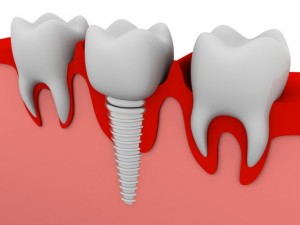 Dental Implants Illustration