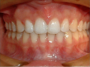 Invisalign Patient After Photo