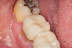 Periodontitis Close-up