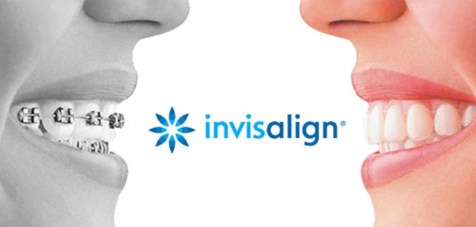 invisalign or braces